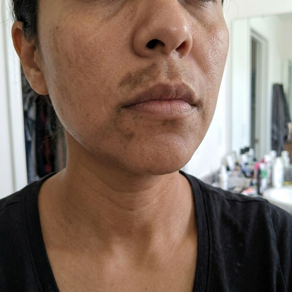 Close-up of melasma pigmentation on woman's chin and upper lip